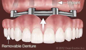 implants-support-removable-dentures